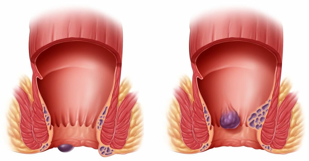 Gelarex hilft bei internen und externen Hämorrhoiden