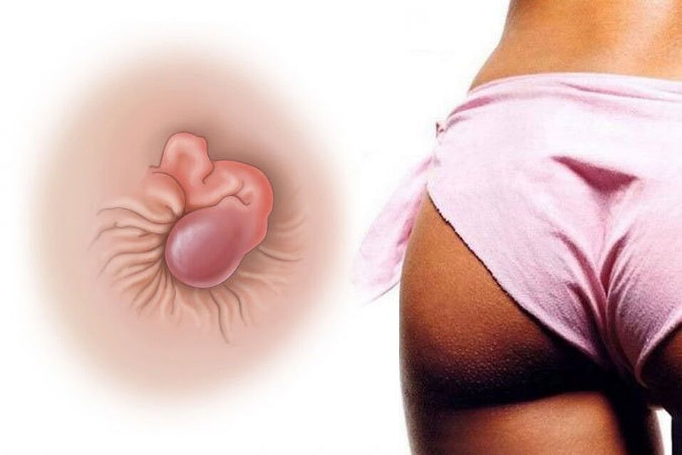 Natürliche creme -hämorrhoide Behandlungen in einem einzigen Kurs